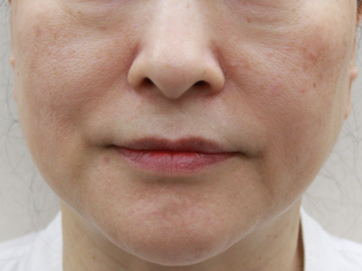 施術2ヶ月後:港区でサーマクールを受けるなら美容外科・美容皮膚科 青い鳥