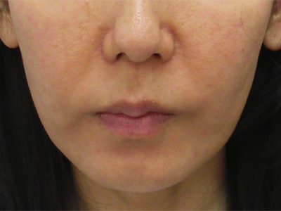 施術3か月後:港区でサーマクールを受けるなら美容外科・美容皮膚科 青い鳥