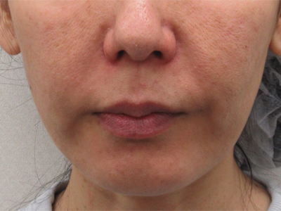 施術前:港区でサーマクールを受けるなら美容外科・美容皮膚科 青い鳥