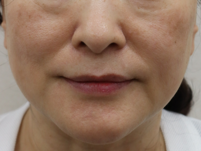 施術前:港区でサーマクールを受けるなら美容外科・美容皮膚科 青い鳥