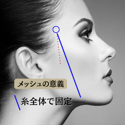 メッシュの意義:港区でテスリフトを受けるなら美容外科・美容皮膚科 青い鳥