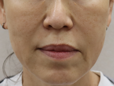 施術1か月後：港区でボブリフトを受けるなら美容外科・美容皮膚科 青い鳥