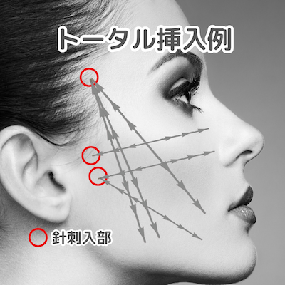 ボブリフト・トータル糸の挿入例：港区でボブリフトなら美容外科・美容皮膚科 青い鳥